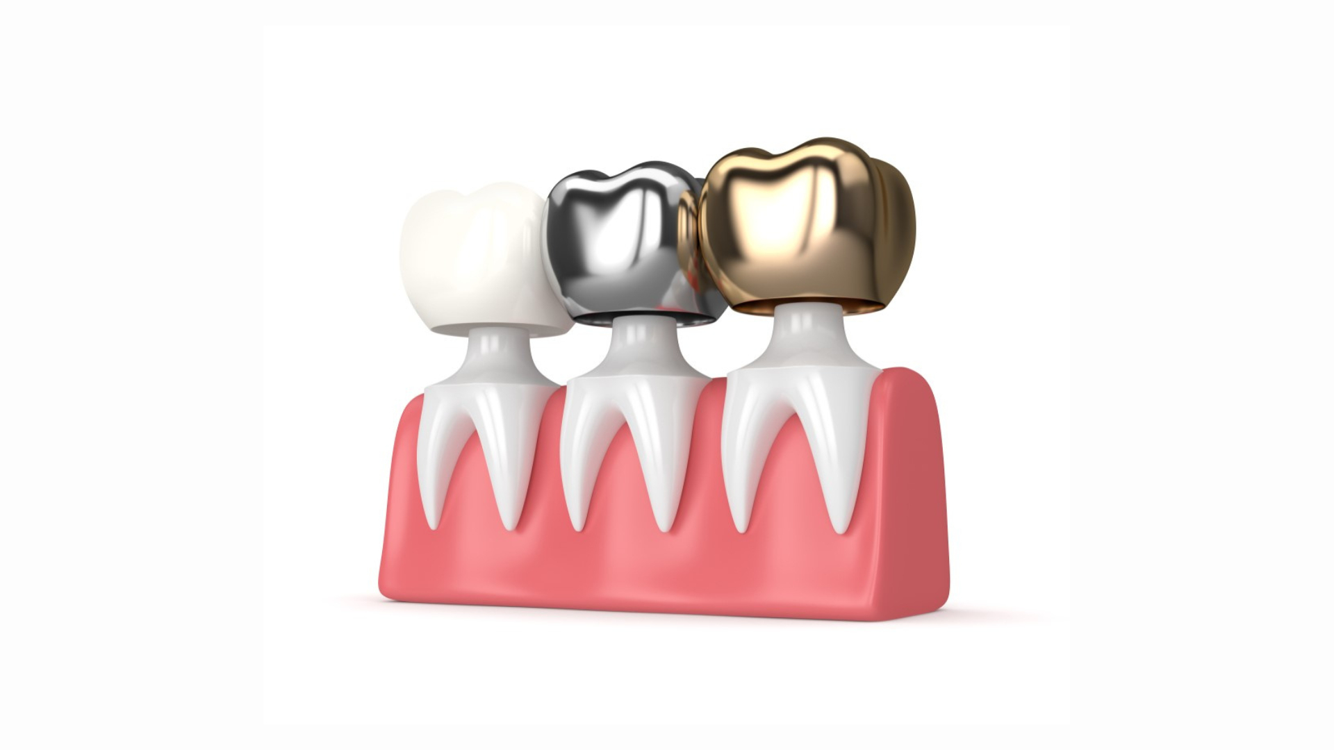 Dental Crowns2