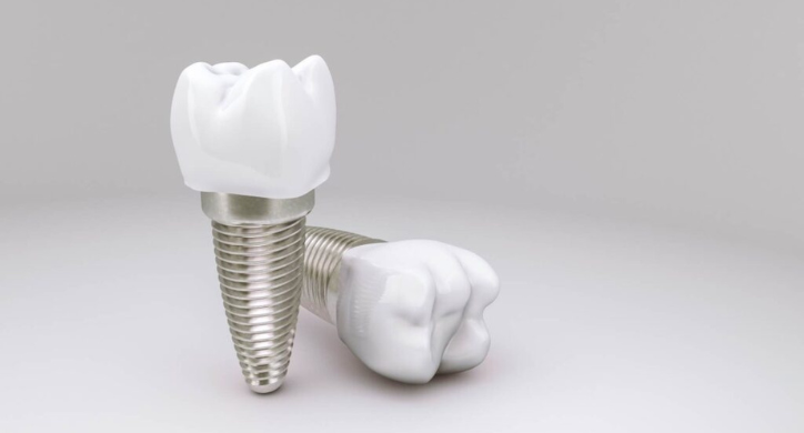 Dental Implants dubai